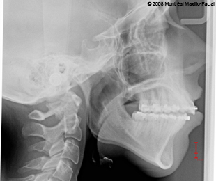 Marie-Hélène Cyr - Cephalometric X-ray before the orthognathic surgery (March 5, 2008)